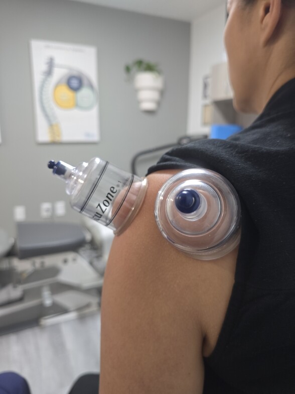 Cupping therapy treatment for muscle recovery and pain relief